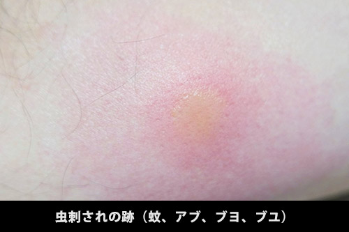 ダニの噛み跡二箇所 _ ダニに噛まれたらどんな症状が出る – CXOZ